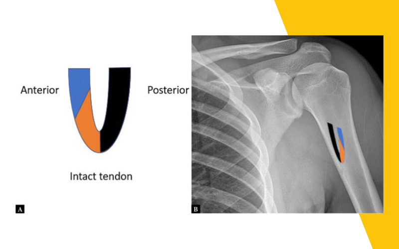 4. Evaluacion lesiones pectoral mayor ecografia tempo formacion.png